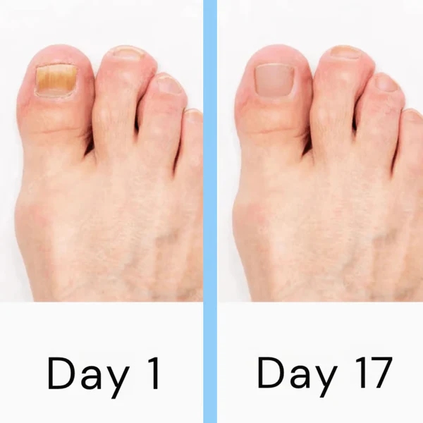 ClearNail Pro Laser Device – Non-Invasive Low-Level Laser Therapy for Fingernail & Toenail Care at Home
